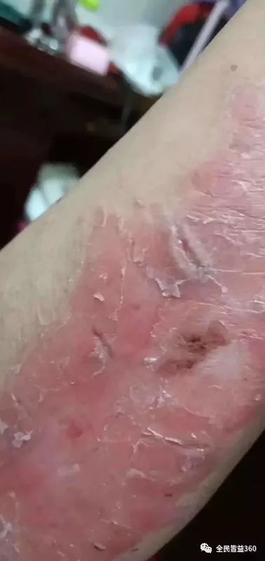 记住,巴克三剑客可以拿下90%的皮肤问题!