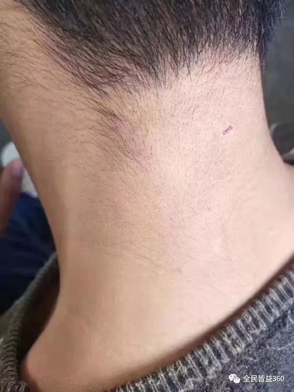 记住,巴克三剑客可以拿下90%的皮肤问题!