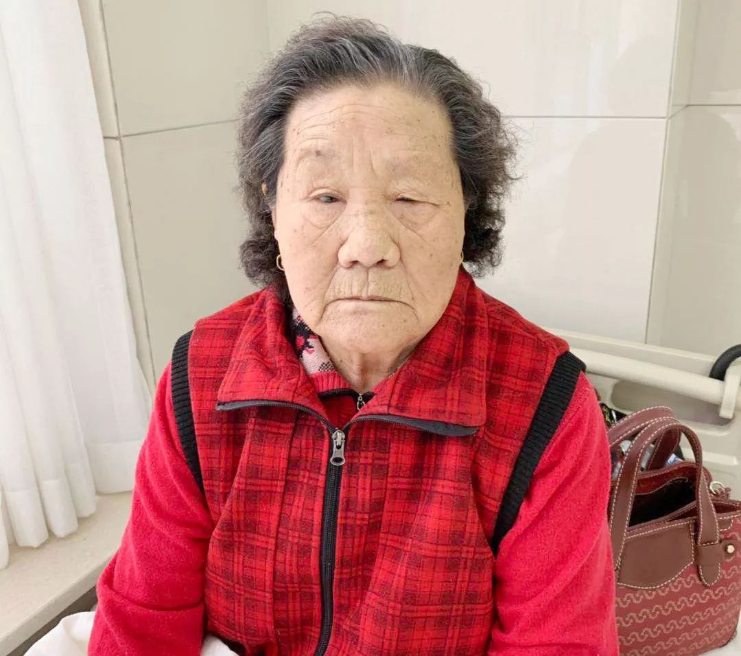 88岁"面瘫"患者遇上"朱氏头皮针",一根银针显奇效