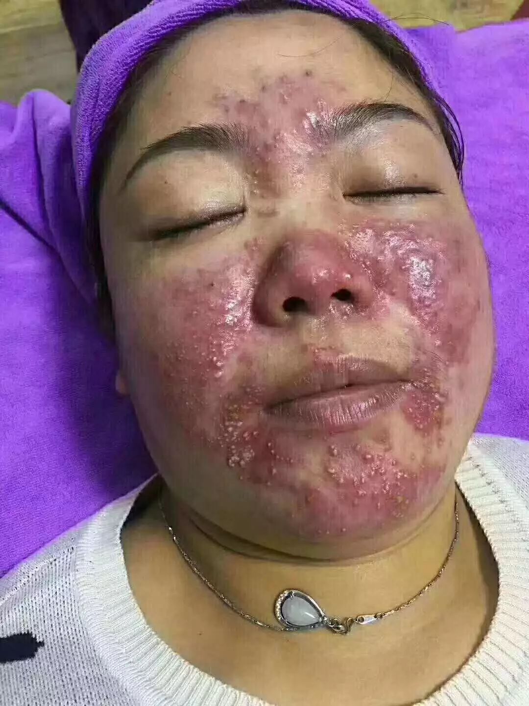 攸慕:你的激素脸是怎样养成的